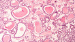 Photomicrograph showing histology of a benign thyroid nodule in a patient with multinodular goiter.  Follicles of varying size are seen, many filled with colloid material.