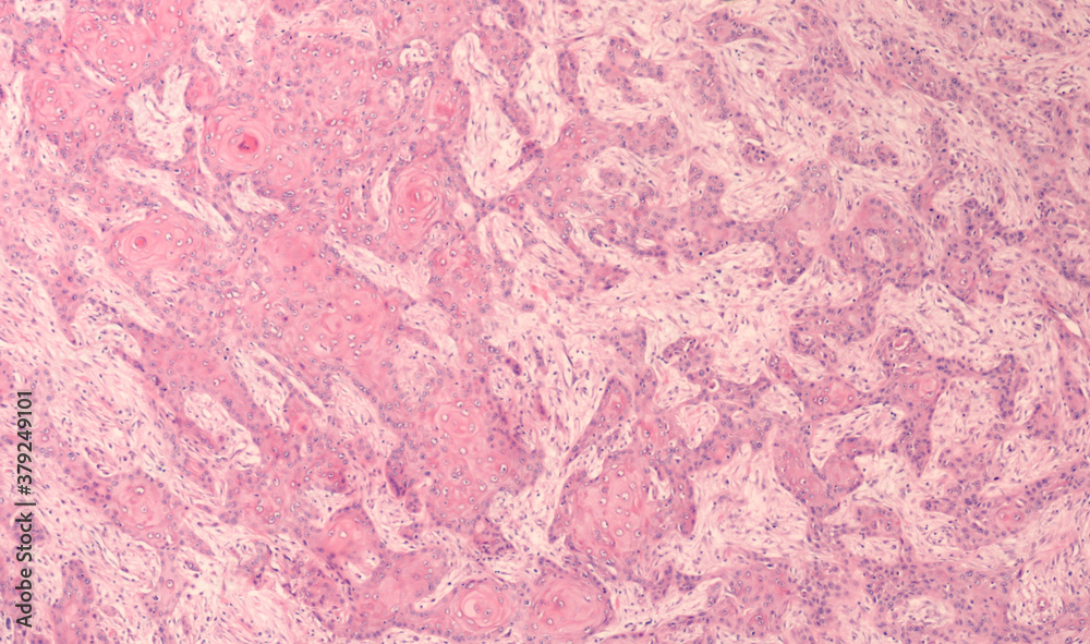 Photomicrograph showing histology of an invasive squamous cell carcinoma.  