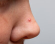 © studybos - inflamed acne on the nose