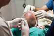 Hair transplantation is a surgical technique that moves hair follicles from a part of the body called