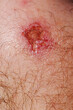 © Urs Siedentop & Co/Stocksy - Skin one's knee. Healing wound close up