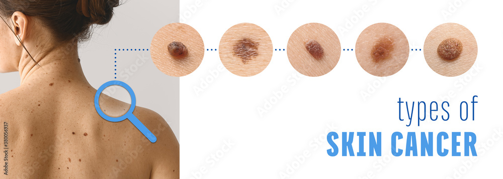 Young woman with different types of moles. Concept of skin cancer - obrazy, fototapety, plakaty 