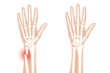 Poster - Fracture x ray concept