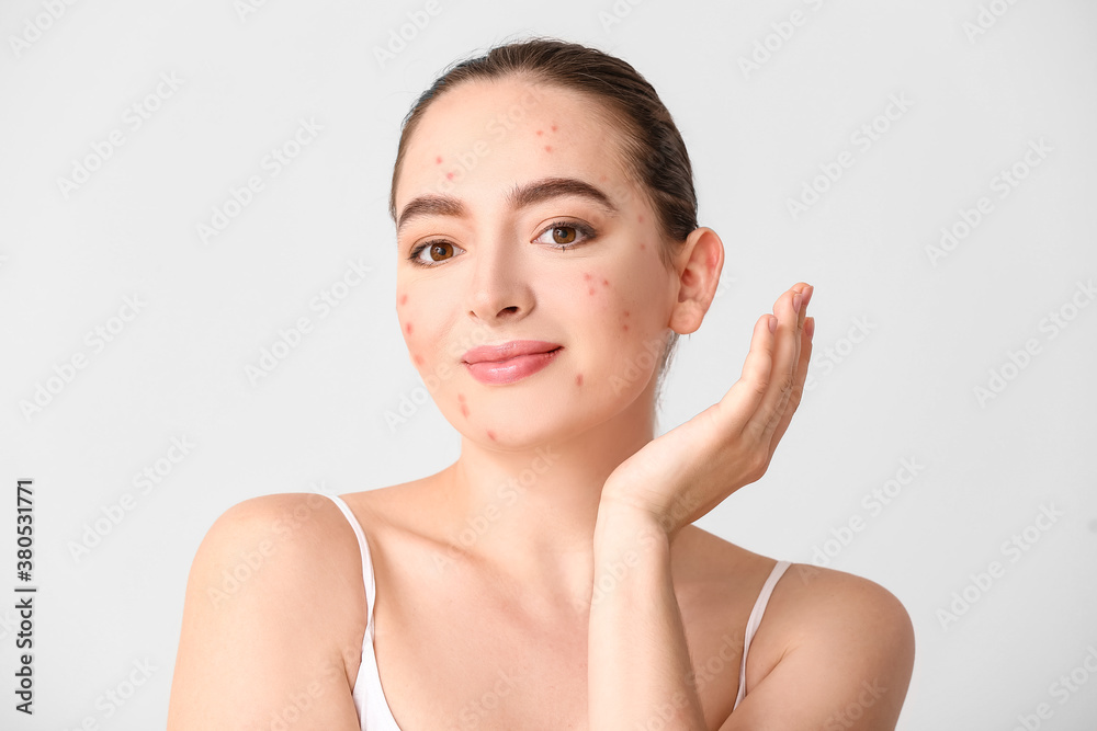 Young woman with acne problem on light background