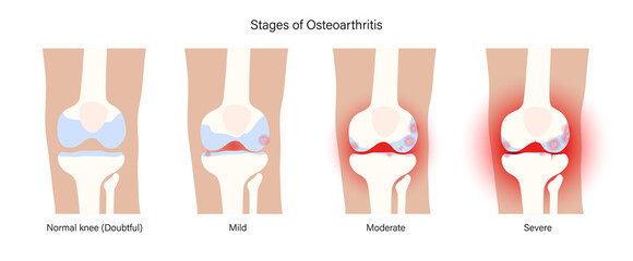 Wall Mural - Arthritis in knee joint