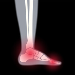 Sticker - Arthritis foot concept