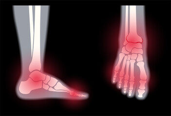 Sticker - Arthritis foot concept