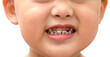 Tooth decay of children who like to eat sweets candy. And doesn't like brushing teeth
