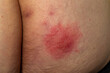 © Aleksandr Lesik - Shingles (disease). Sympton of the Herpes virus on the human body. Skin rash and blisters on the body