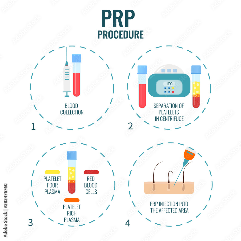Vector de Stock Platelet rich plasma procedure stages. PRP hair loss ...