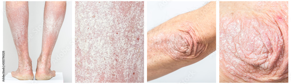 Panel Collage of acute psoriasis on the elbows and legs of a man - an ...