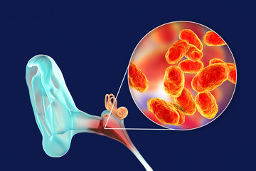 Wall Mural - Otitis media, inflammatory disease of the middle ear