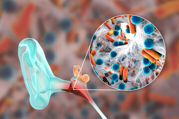 Wall Mural - Otitis media, inflammatory disease of the middle ear