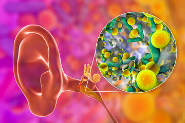 Wall Mural - Otitis media, inflammatory disease of the middle ear