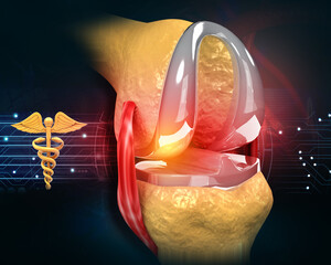 Sticker - Human knee joint  replace anatomy on medical background. 3d illustration.