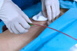 Scrub nurse pull introducer sheath from femoral artery and press at puncture site of patient’s groin
