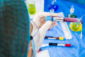 Creatinine blood test tube sample in doctors hand in laboratory