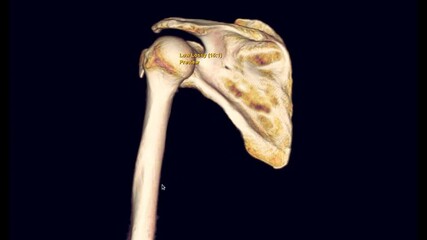 Poster - CT scan 3D rendering of Left shoulder showing fracture head of humerus .