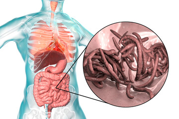 Sticker - Parasitic worms in human small intestine