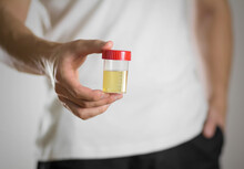 A Man Holds A Jar With A Urine Test. Close Up