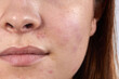 © justoomm - face close-up of redness and pimples skin cleansing