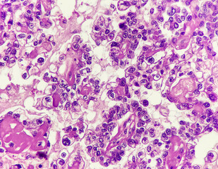 Clear cell carcinoma of the ovary, papillary pattern, magnification 400x, photo under microscope