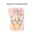 Rupture of the quadriceps tendon.