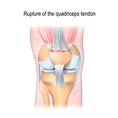 Poster - Rupture of the quadriceps tendon.