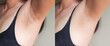 Image before and after skincare cosmetology armpits epilation treatment concept.Problem underarm chicken skin,Fox Fordyce,black armpit in woman.