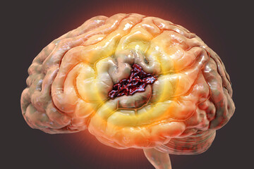 Poster - Hemorrhagic stroke, illustration