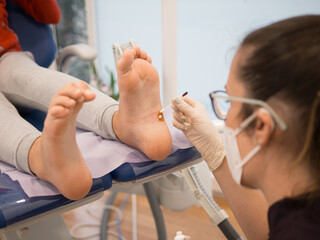 Podiatrist treating a wart verrucas plantar