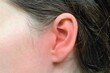 © Tunatura - Woman's ear with red marks of inflammation, health problem