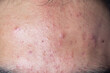 © sinhyu - Backgrounds of lesions skin caused by acne on the face in the clinic.