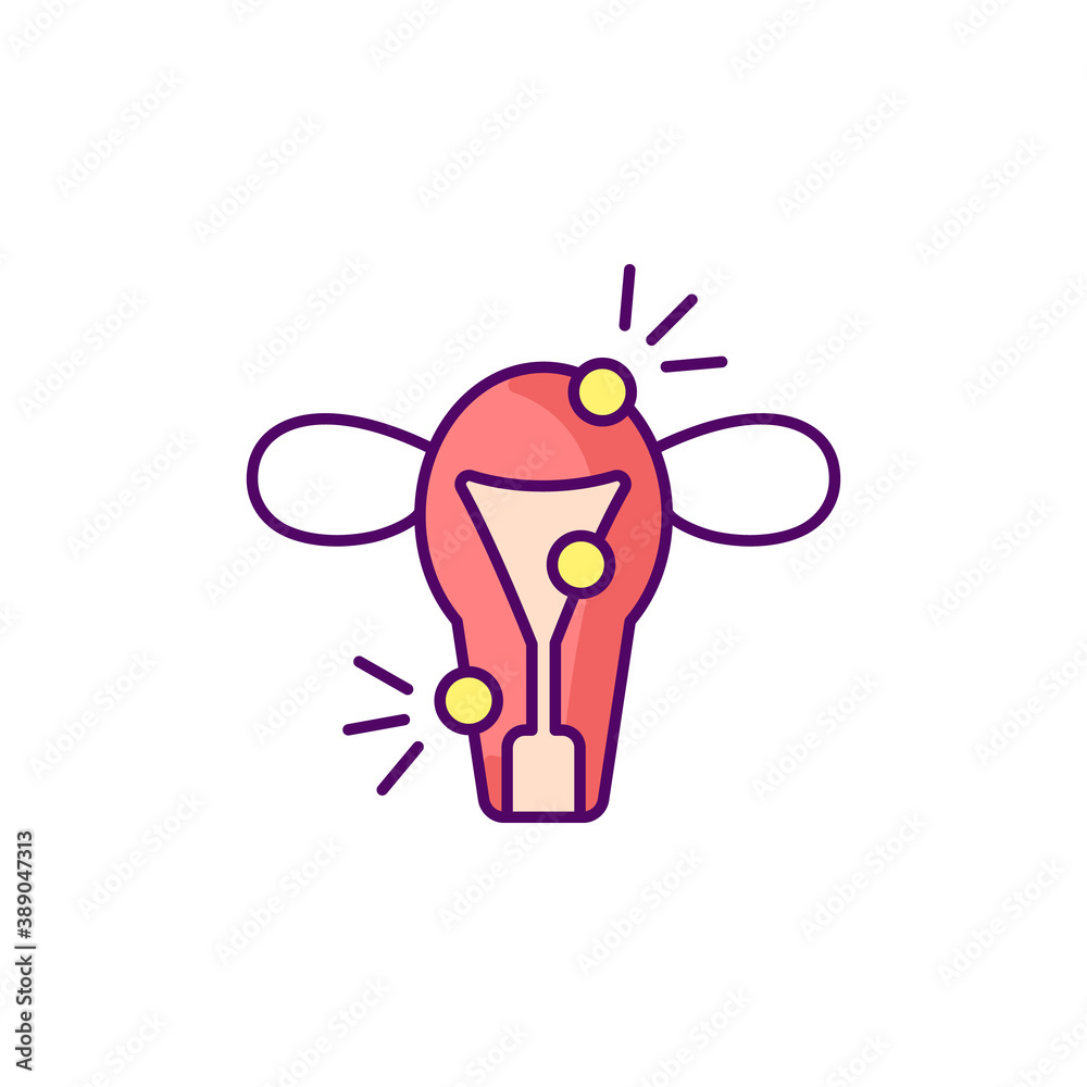 Endometriosis RGB color icon. Painful disorder. Endometrium. Ovaries ...