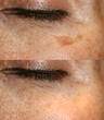 © timonina - Brown spot on the skin of the face. Pigmentation on the skin. After laser removal