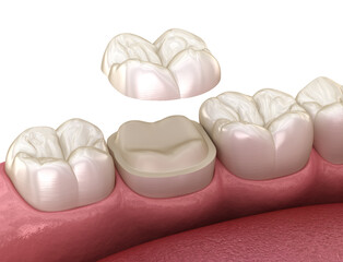 Wall Mural - Onlay ceramic crown fixation over molar tooth. Medically accurate 3D illustration of human teeth treatment