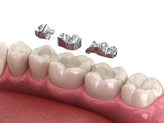 Wall Mural - Amalgam restoration. Medically accurate 3D animation of dental concept