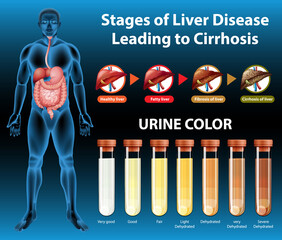 Poster - Stages of liver disease leading to Cirrhosis