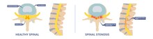 Spinal Stenosis A Narrowing Of The Spaces Of The Spine That Causes Lower Back Pain Annulus Nucleus Bulged Older Cord Muscle Weakness Neck Cauda Equina Injury Cushioning  Vertebrae Disk Bone