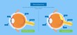 Retinoblastoma blind ophthalmologist retinocytoma ophthalmology anatomy cornea squint
