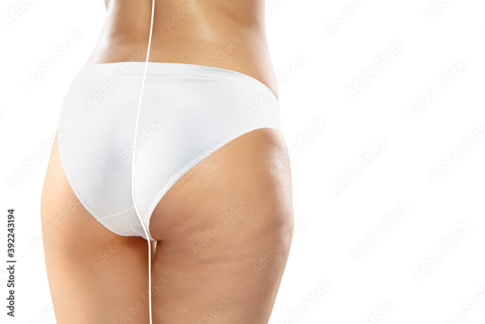 Overweight woman with cellulite legs and buttocks in white underwear comparing with fit and thin body isolated on white background. Orange peel skin, liposuction, healthcare, beauty, sport, surgery. - obrazy, fototapety, plakaty 