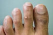 A brown man has corn on the second toe of the left foot by wearing shows all-day