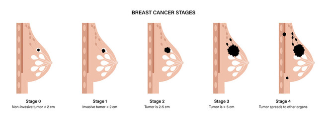 Sticker - Breast disease concept