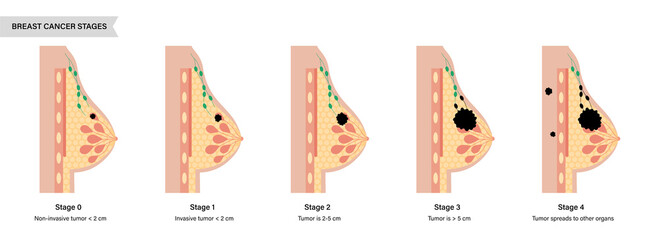 Wall Mural - Breast disease concept