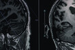 MRI of brain Dementia protocol with Alzheimer's disease  Take a picture from the computer 