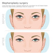 Lower and upper rejuvenation blepharoplasty surgery illustration. Rejuvenating procedure. Wrinkles around the eyes before and after. 