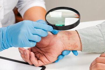 Wall Mural - A dermatologist wearing gloves examines the skin of a sick patient. Examination and diagnosis of skin diseases-allergies, psoriasis, eczema, dermatitis