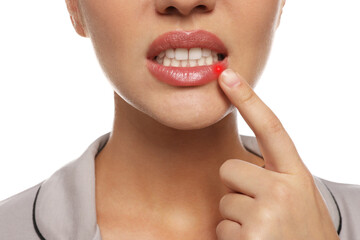 Canvas Print - Woman with herpes touching lip on white background, closeup