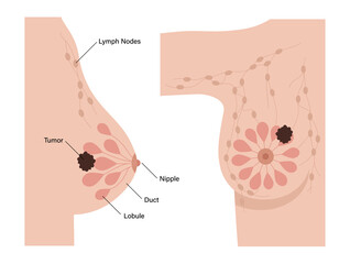 Sticker - Breast disease concept