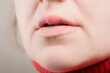 © SerPhoto - Female lips with symptoms of herpes virus